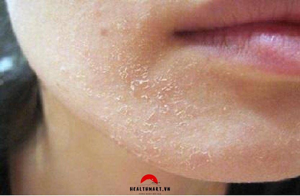9 nguyên nhân khiến vùng da quanh mũi bị khô, các cách chăm sóc vùng da khô xung quanh mũi 2