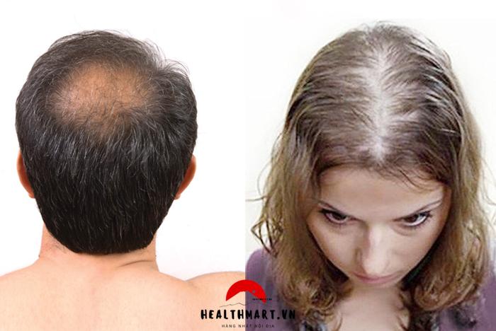 Phân biệt rụng tóc sinh lý và rụng tóc bệnh lý, Các giai đoạn rụng tóc 2