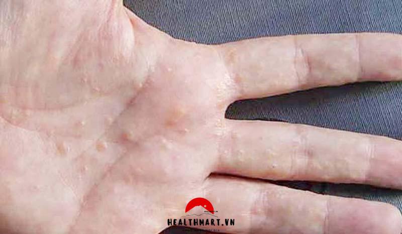 Tay Bi Ngua Noi Mun Nuoc.jpg