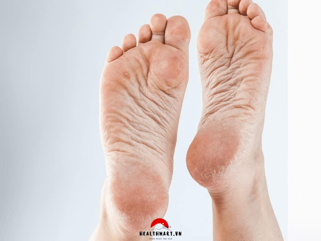 Nguyên nhân gót chân bị nứt nẻ, 11 cách trị nứt gót chân từ nguyên liệu tự nhiên hiệu quả 2